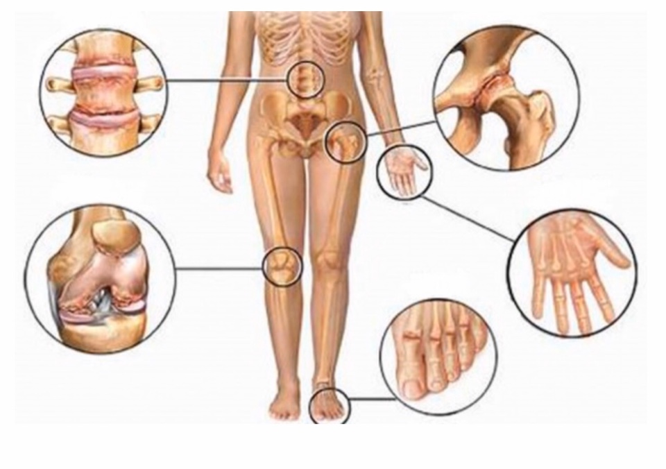 Cos’è l’Artrite Reumatoide?