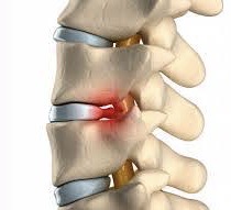 Ernia del disco lombare