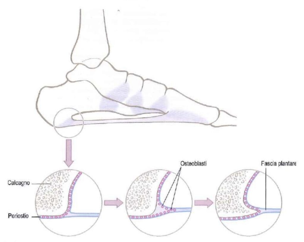 Spina calcaneare, cos’è e come curarla!