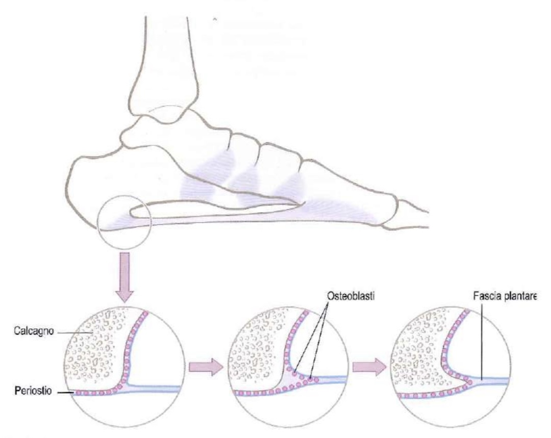 Spina calcaneare, cos’è e come curarla!