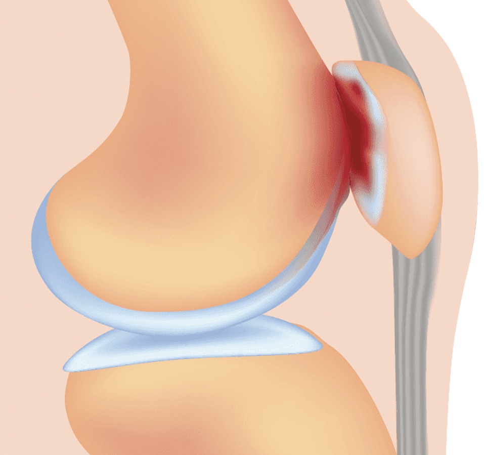 La Sindrome femoro-rotulea